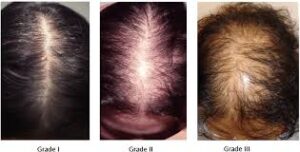 Androgenic Alopecia