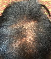 Scarring Alopecia