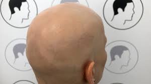 Alopecia Areata Totalis