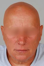 Alopecia Areata Universalis